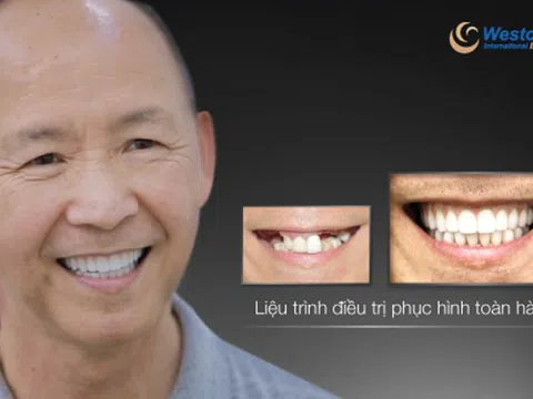 Khắc phục hậu quả trồng răng implant thất bại